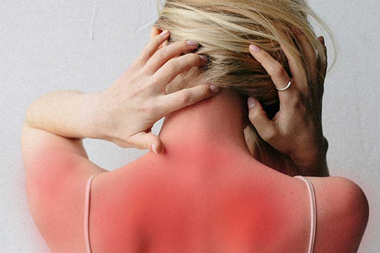 second degree burn causes