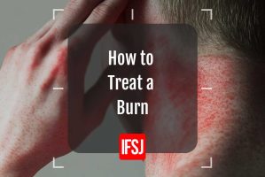 how to treat a burn